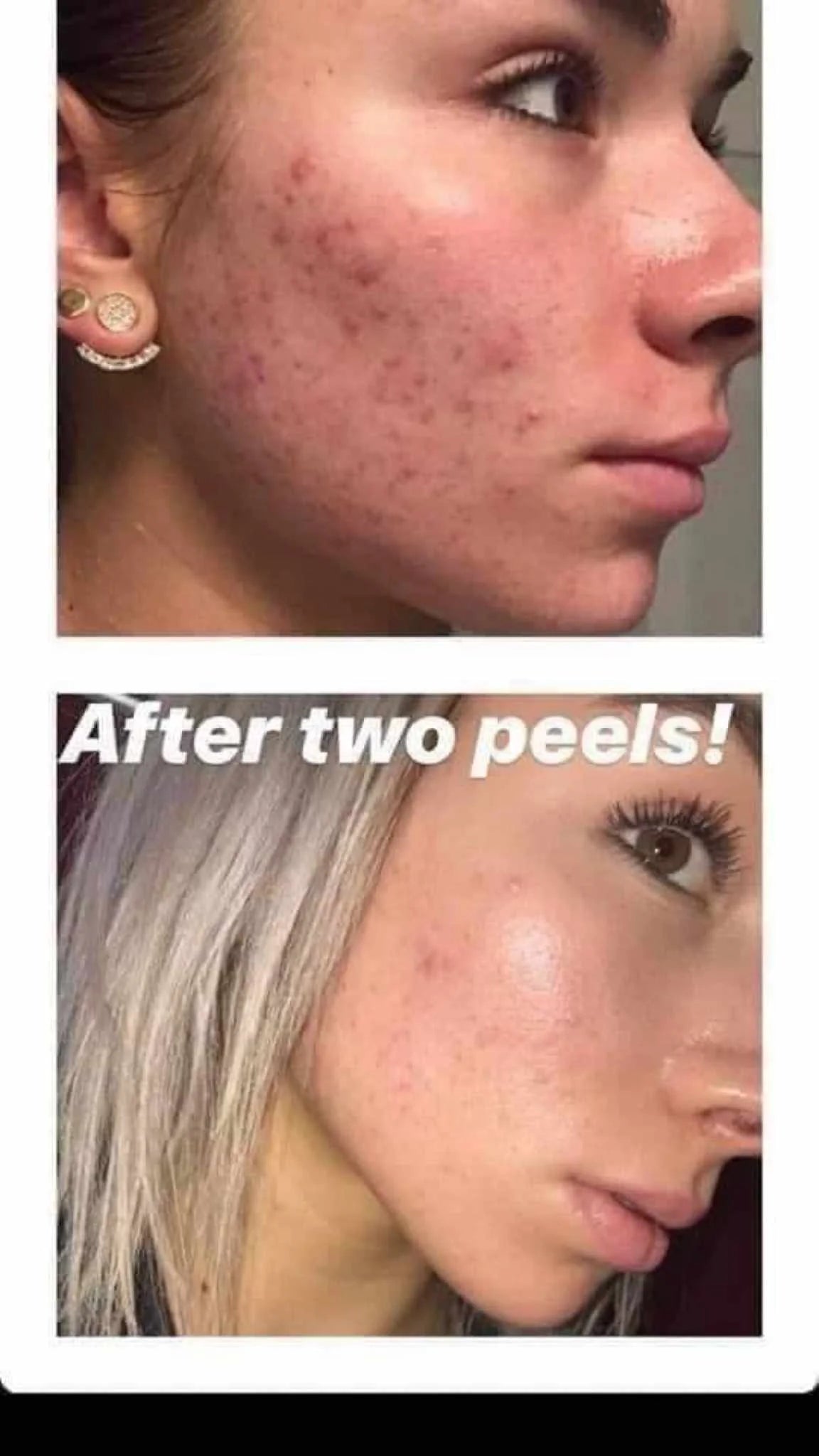 180° AHA Facial Peel and Neutralizer